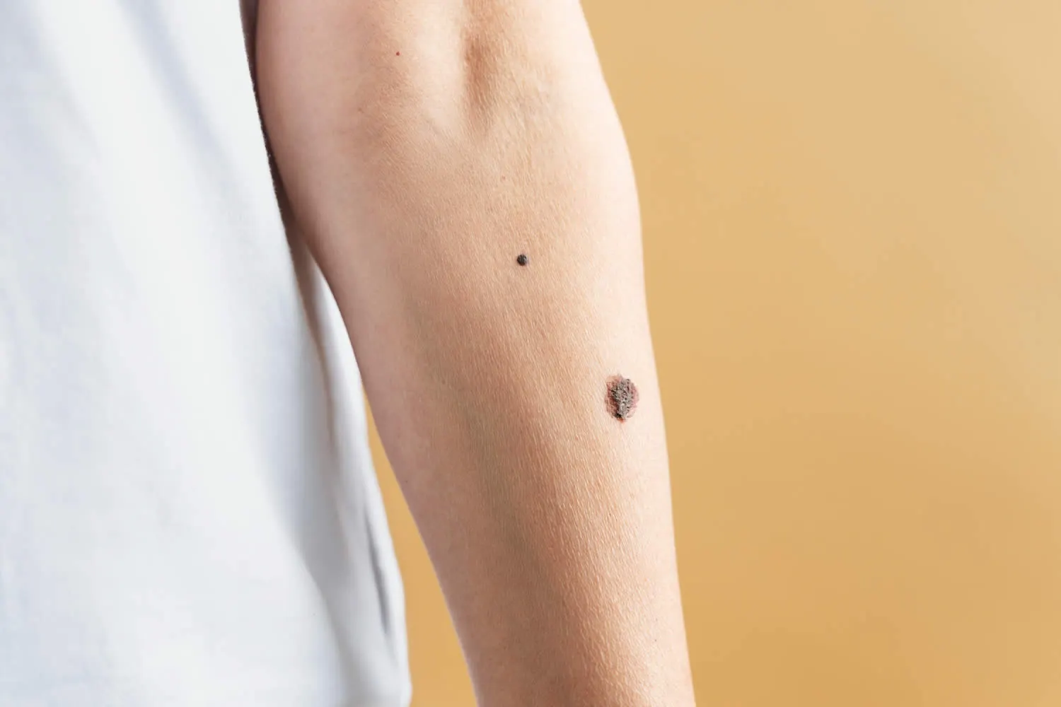 medical dermatology woman close-up-hand-with-different-size-moles