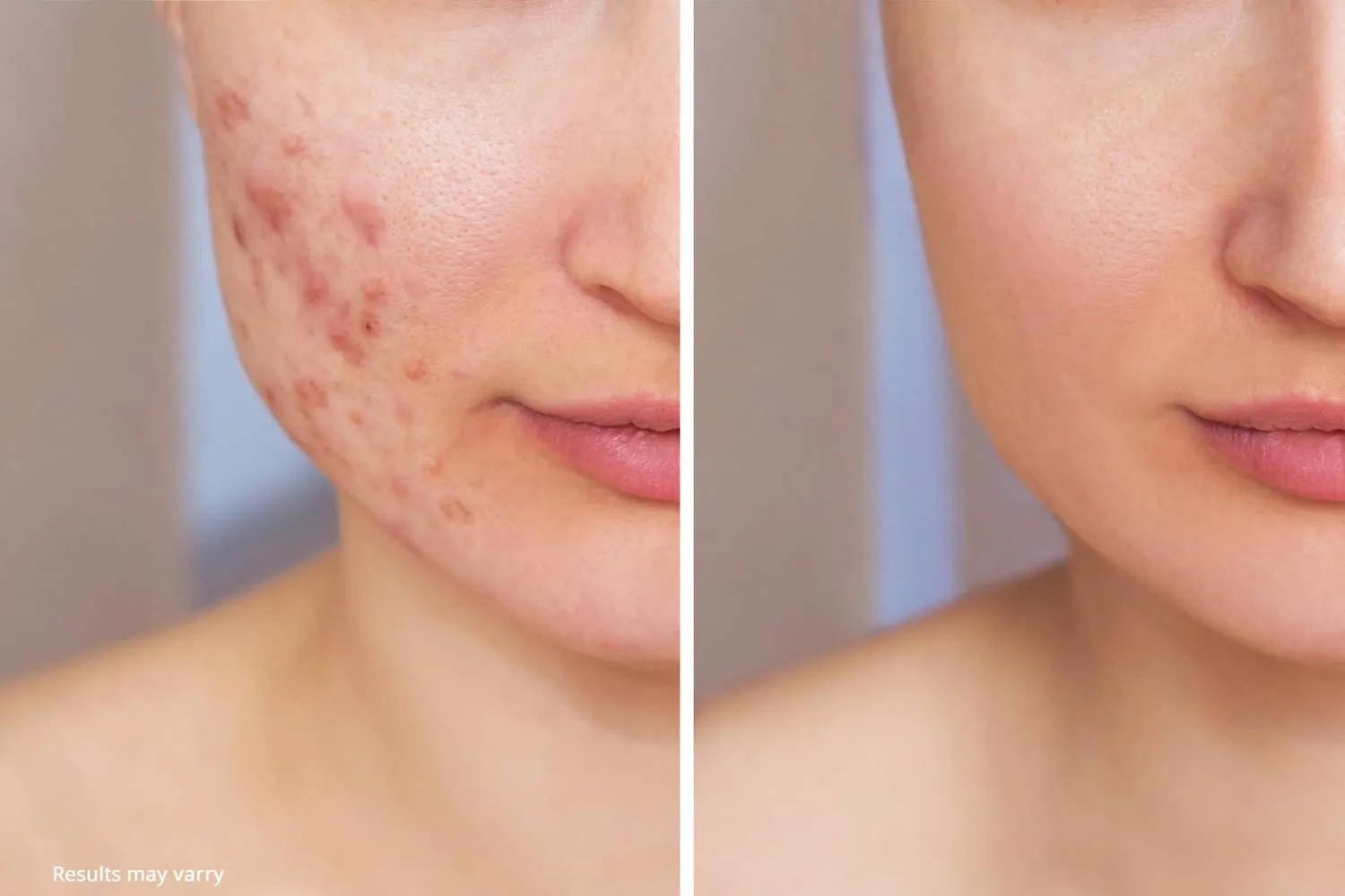 medical dermatology woman face-before-after-acne-treatment-aviclear-laser